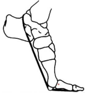 Schematic of a hyper-dorseflexed proximal toe joint (indicated by red star).
