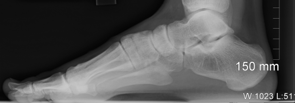 An X-ray of my foot. Note that most of the individual foot bones are filled with tiny 'spicules' (=trabeculae) of bone. Very often they have a very directed, or non-random, orientation, such as in the heel.