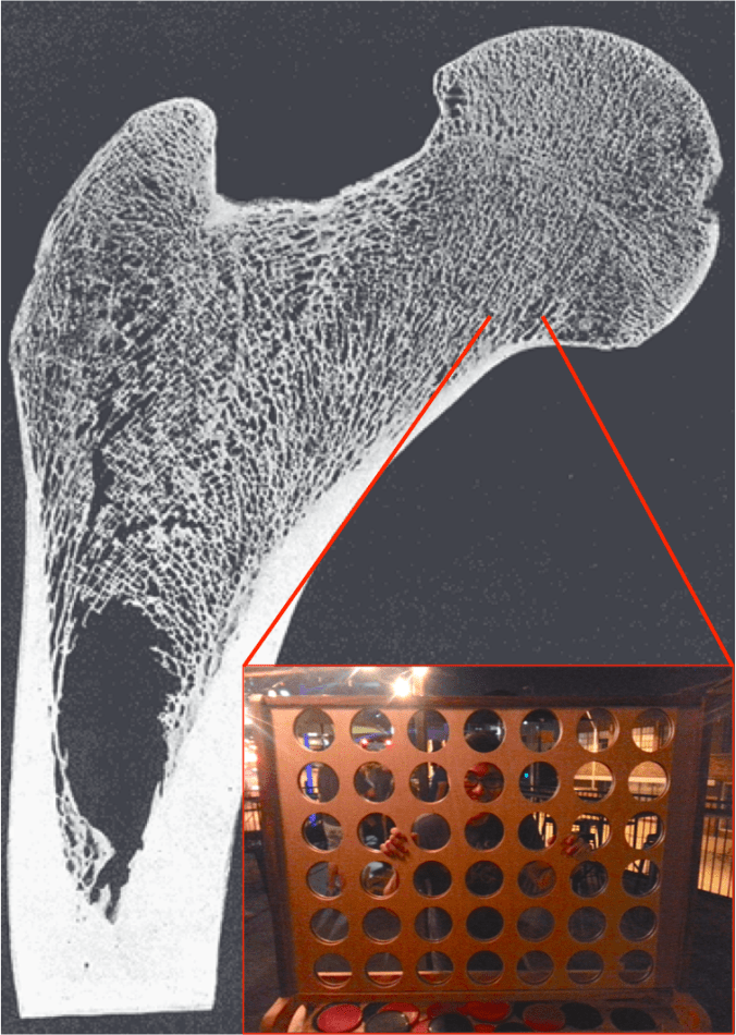 Section through a human proximal femur (hip joint). Note the trabecular or "spongy" bone filling the top, in comparison with the thick and dense cortical bone of the shaft in the bottom left. Image credit.